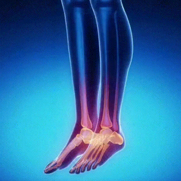 Orthessa® - Loop weer pijnvrij door elke dag